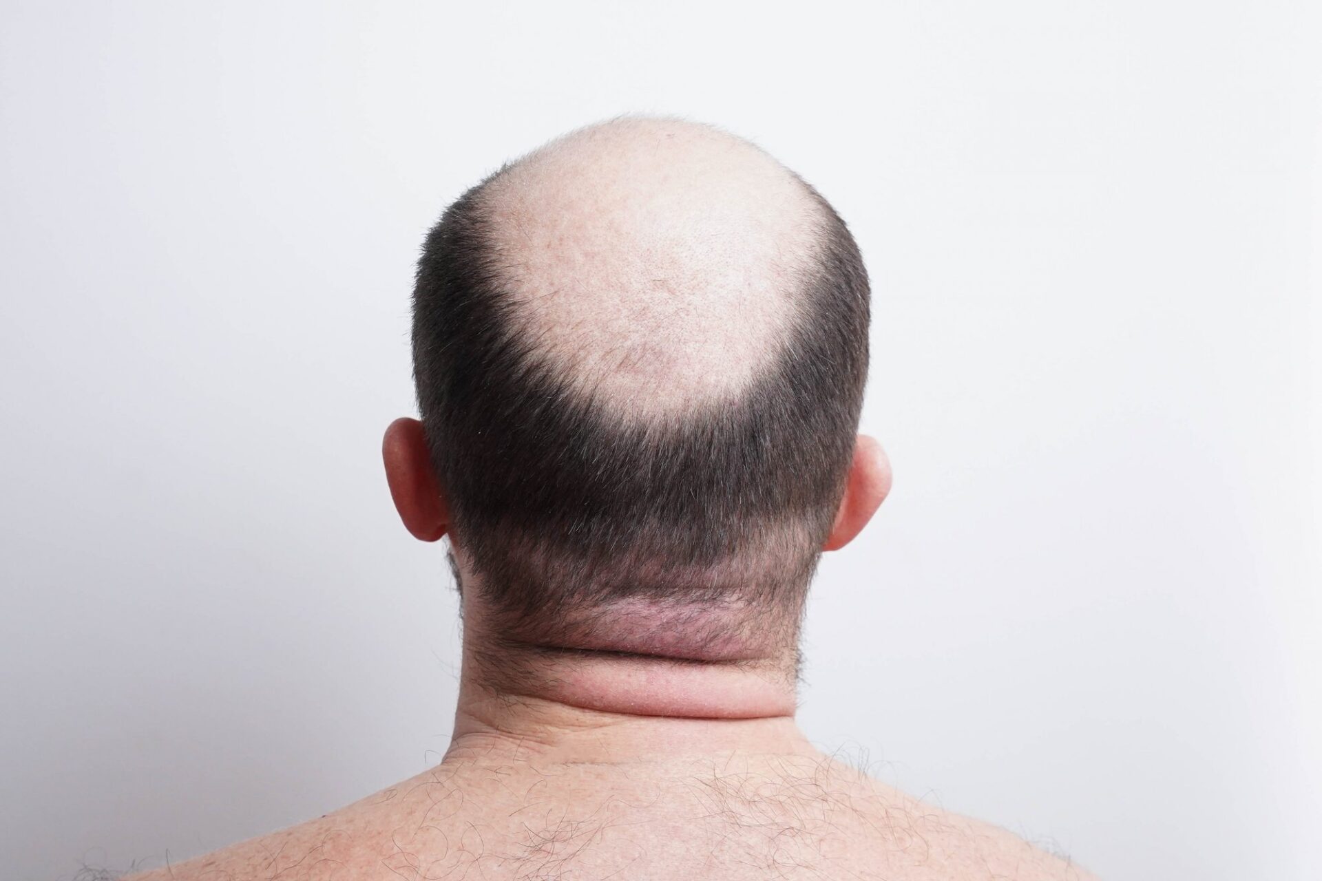 A previously unknown mechanism of hair growth on the scalp has been discovered, promising new methods for promoting natural hair development.